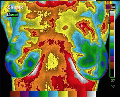 Breast Thermography