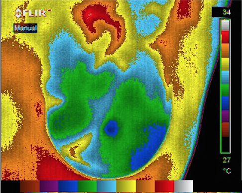 Breast Thermography